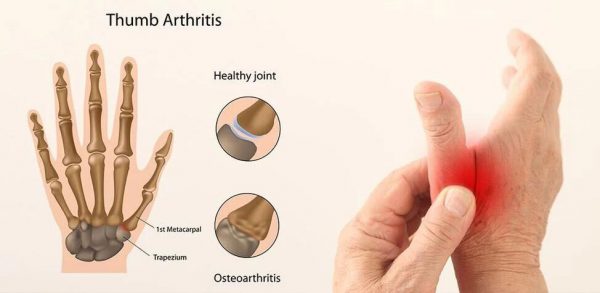 Was ist Daumenarthritis