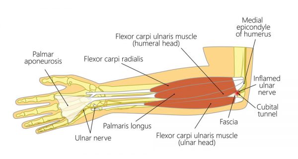 O que é irritação do nervo ulnar?