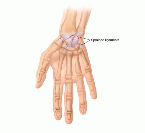 What Is Wrist Sprain