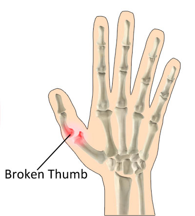 O que é um polegar quebrado?