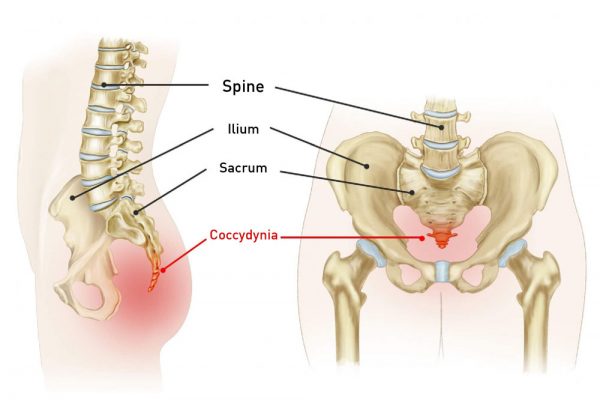 What are Coccydynia symptoms?