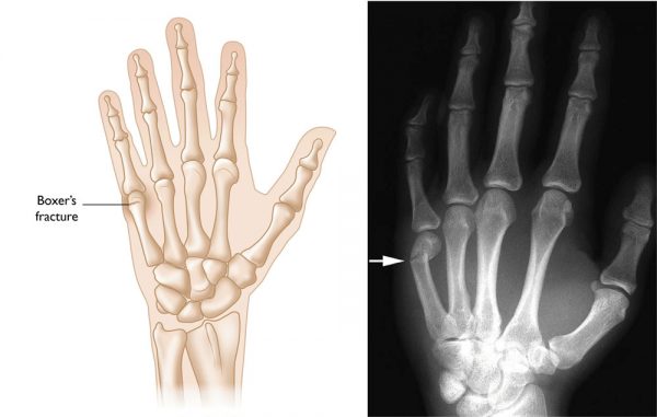 ¿Qué son las fracturas de dedo?