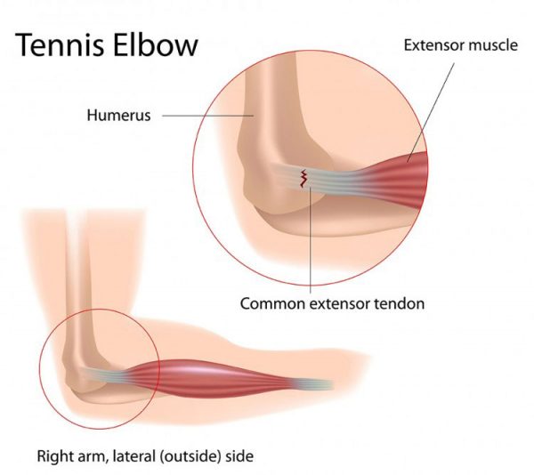 Que sont les entorses du tendon ?
