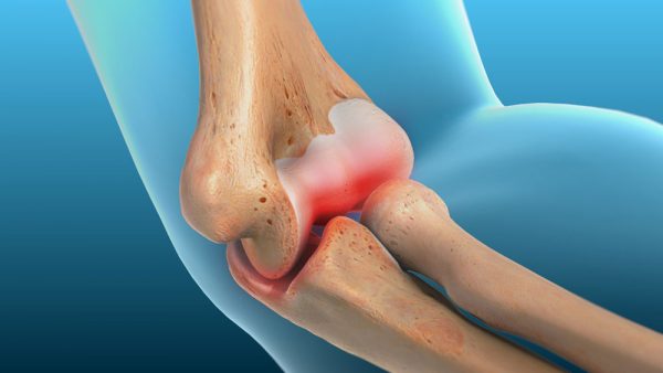 Quelles sont les causes des entorses du tendon ?