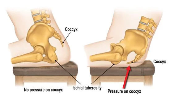 What causes and what are the symptoms of Coccydynia?