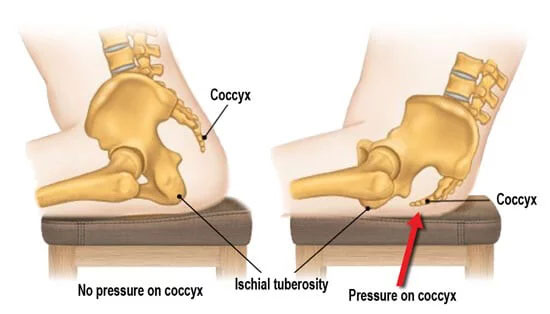 https://www.worldbrace.com/wp-content/uploads/2022/07/What-causes-and-what-are-the-symptoms-of-Coccydynia.jpg