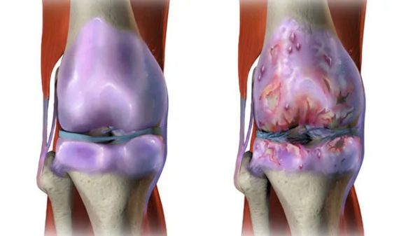 Qu'est-ce que l'arthrite du coude?