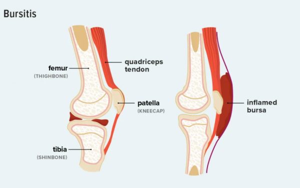 ¿Qué es la tendinitis?