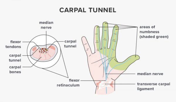 O que é a síndrome do túnel do carpo