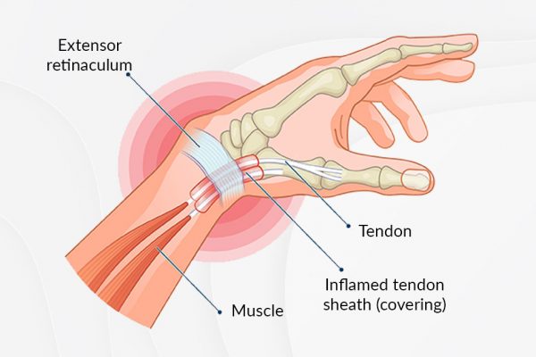 ما هو De Quervain & #039؛ s Tenosynovitis؟