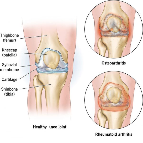 Was ist Ellenbogenarthritis?