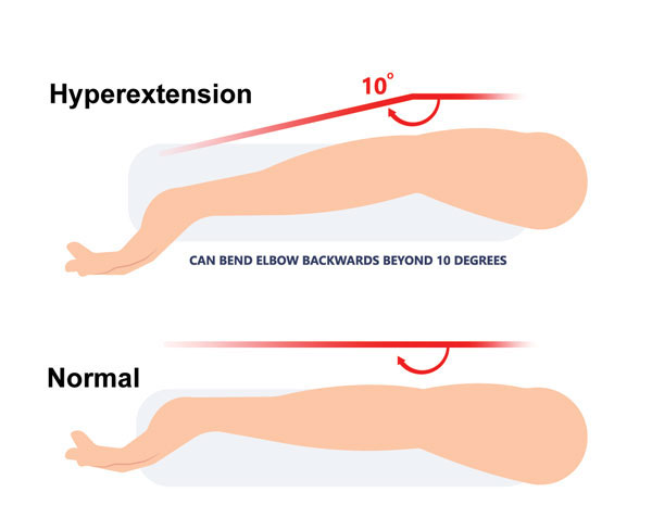 What is Elbow Hyperextension?