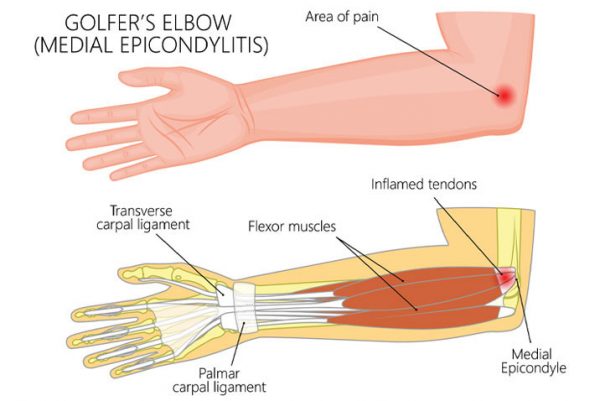 What is Golfer's Elbow?