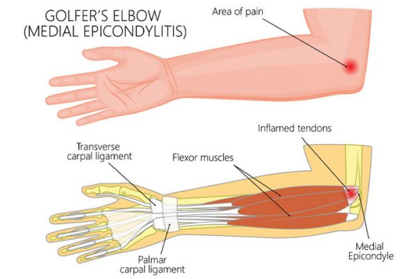 Qu'est-ce que le coude du golfeur ?