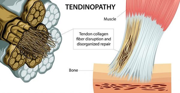 ¿Qué es la tendinitis?