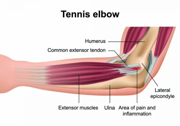 Was ist ein Tennisarm?