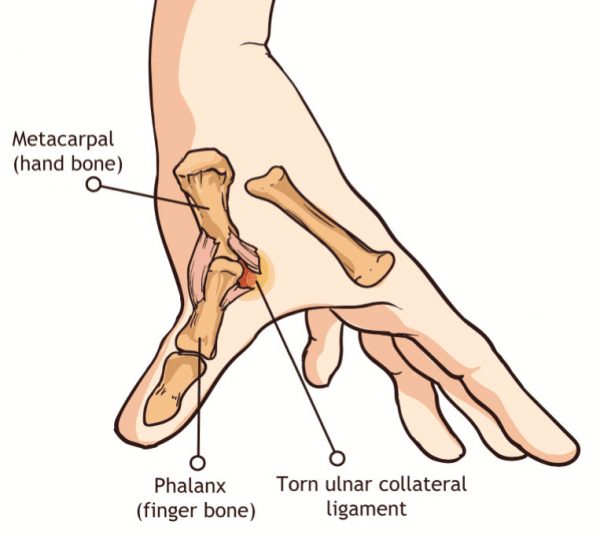 ¿Qué es el esguince de pulgar?