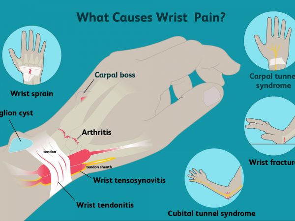 Qu'est-ce que l'arthrite du poignet ?