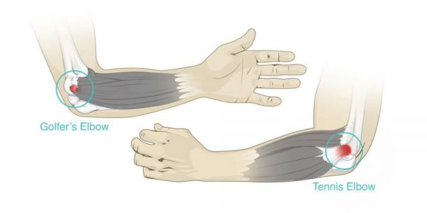 What is the difference between tennis and a golfer's elbow?