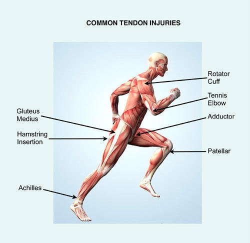 lesiones comunes de los tendones