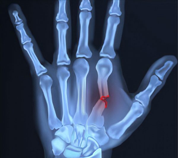 hand-fractures-symptoms