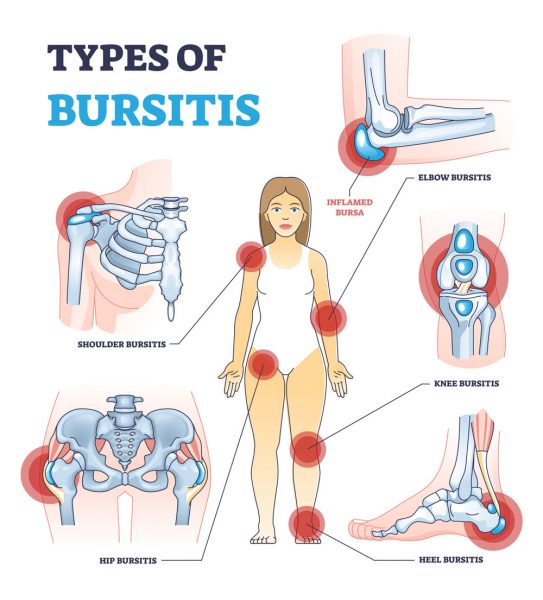 Arten von Bursitis