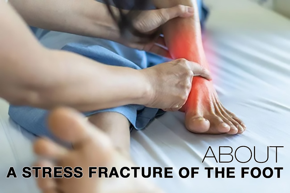 Tratamiento del pie con fractura por estrés