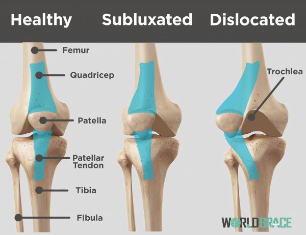 الفرق بين subluxated-an