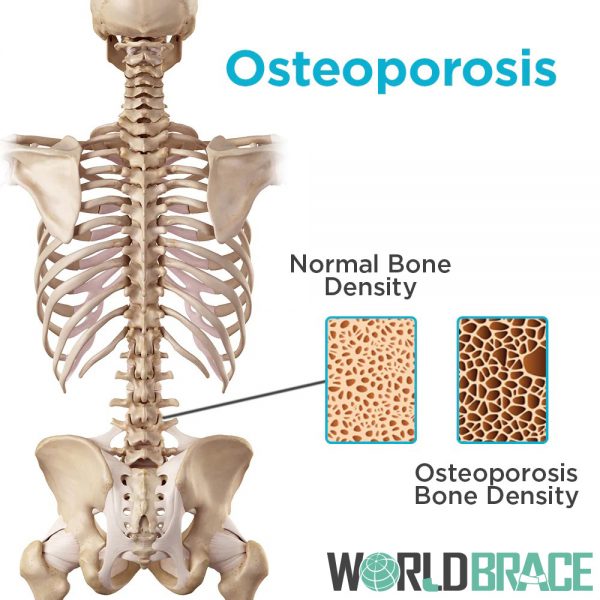 osteoporosis-in-the-spine-lack-o