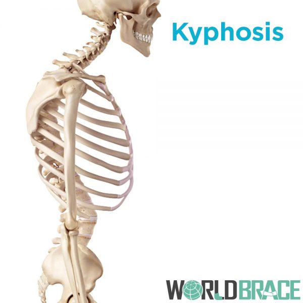 over-arched-back-causing-kyphosi