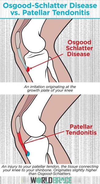 tendinitis-rotuliana-en-rótula-k