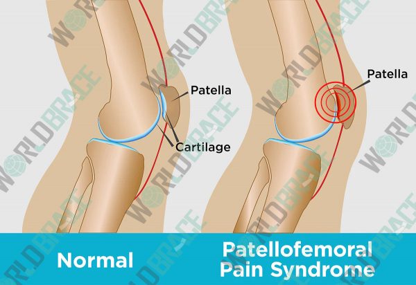 patellofemoral-pain-syndrome-in