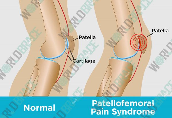 patellofemorales Schmerzsyndrom-in