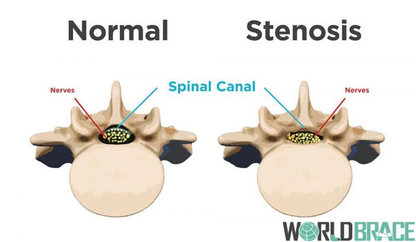 spinal-stenosis-treatment-in-pin