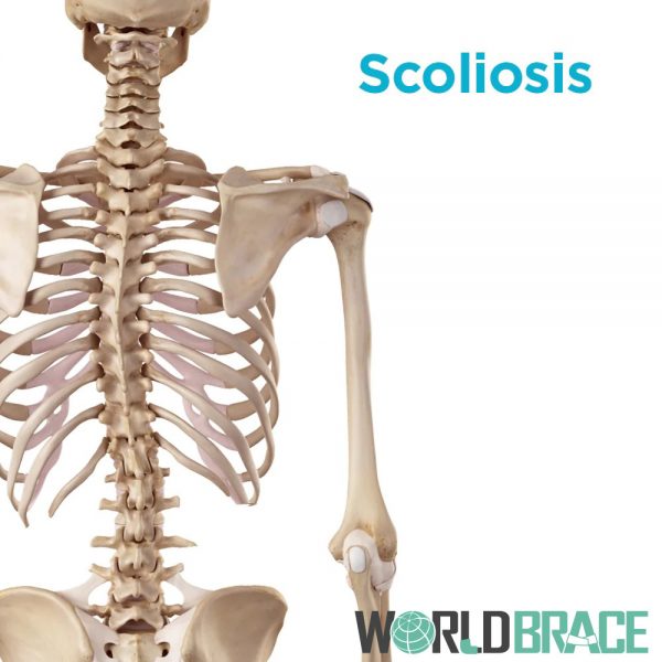 treat-scoliosis-with-a-back-brace