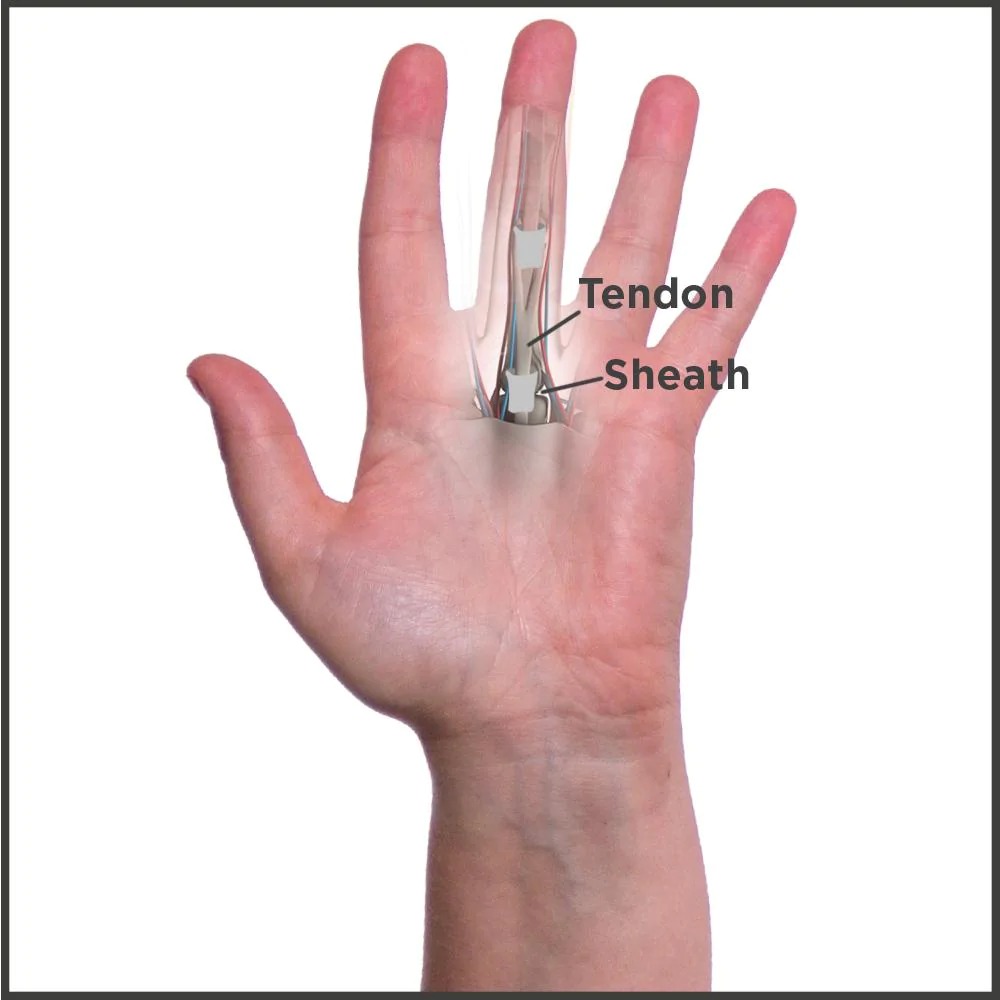 What Exactly Is Trigger Finger Or Stenosing Tenosynovitis? WorldBrace