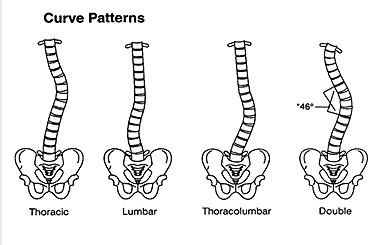 curve-pattern-in-spine-scoliosis