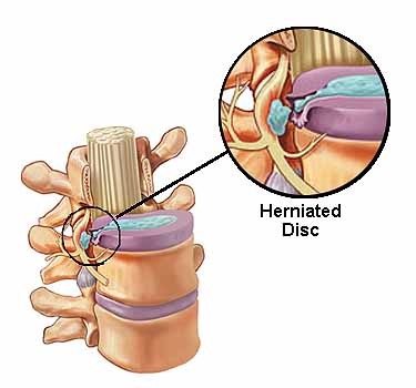 herniated-disc-in-lumbar-back