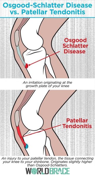 tendinitis-rotuliana-en-rótula-k