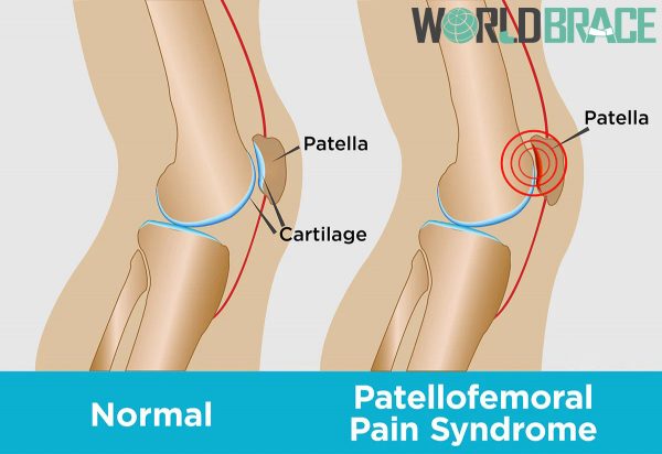 patellofemoral-pain-syndrome-in