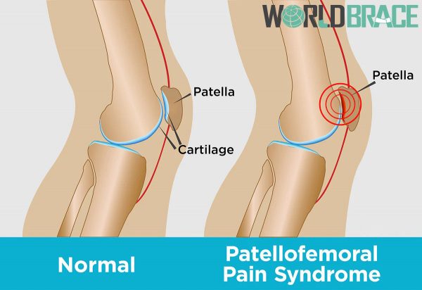 syndrome fémoro-patellaire douloureux