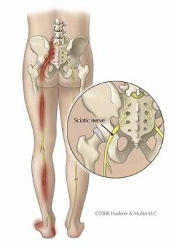 sciatica-sciatic-nerve-pinch
