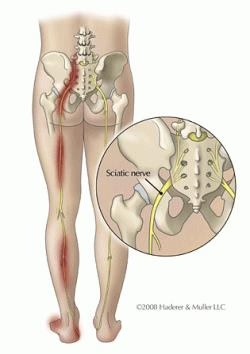 sciatique-nerf-sciatique-pincement