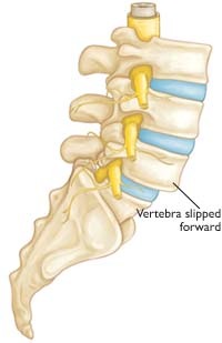 Spondylolisthesis-im-unteren-Rücken